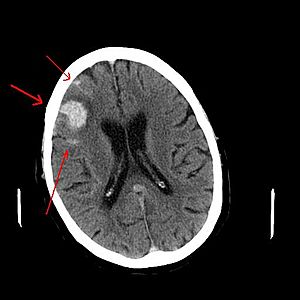 Archivo:Intracerebral