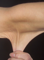 Hyperelastic skin in a case of Ehlers-Danlos syndrome (cropped)