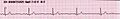 Lead II rhythm generated sinus bradycardia