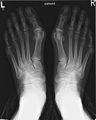 Projectional radiograph of bunion.jpg
