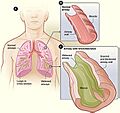 Bronchiectasis NHLBI