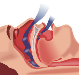Obstruction ventilation apnée sommeil.svg