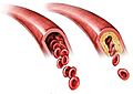 Cerebral-atherosclerosis