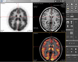 Imagen combinada IRM / PET de una cabeza humana.