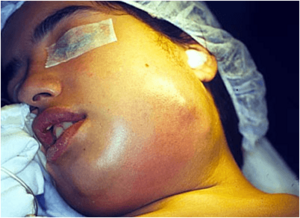 Archivo:Paciente femenina con un absceso en lado izquierdo de la cara