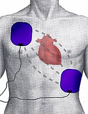 Archivo:Defibrillation Electrode Position