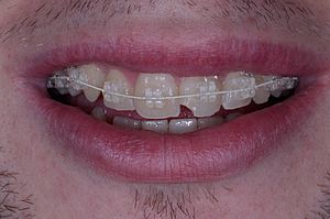 Archivo:Ortodoncia-wikipedia