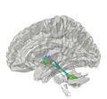 Superior Cerebellar Peduncle