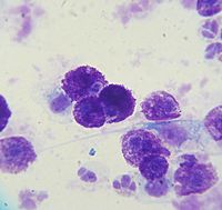 Archivo:Mast cell tumor cytology 2
