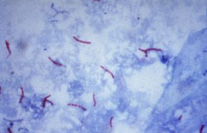 Archivo:Mycobacterium tuberculosis Ziehl-Neelsen stain 02