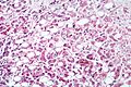 Alcoholic hepatitis