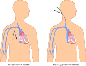 Archivo:Percutaneous central venous catheters