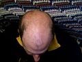 Bald head