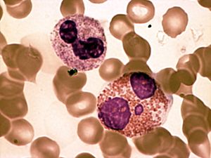 Archivo:Eosinophil and polymorphonuclear neutrophil