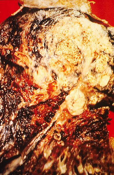 Pathology of the lung (cancer)