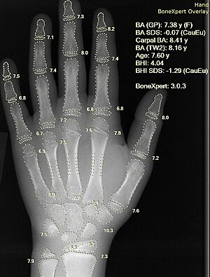 Archivo:X-ray of hand, where bone age is automatically found by BoneXpert software