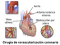 Blausen 0151 CABG 02-es