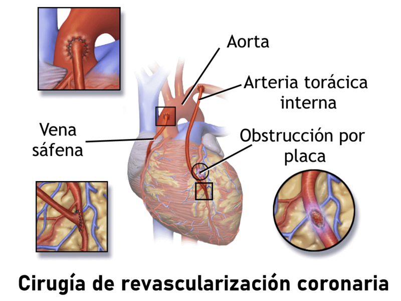 Blausen 0151 CABG 02-es