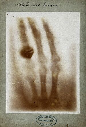 Archivo:First medical X-ray by Wilhelm Röntgen of his wife Anna Bertha Ludwig's hand - 18951222