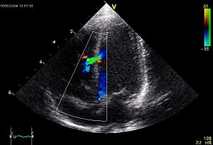Archivo:Ventricular Septal Defect