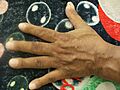 Clubbed fingers