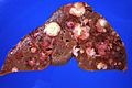 Human liver with metastatic lesions from primary pancreas carcinoma (2)