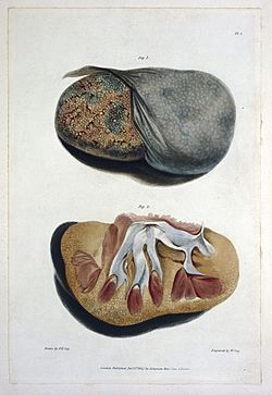 Richard Bright, "Reports of medical cases" Wellcome L0013468.jpg