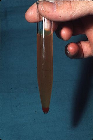 Hematuria.jpg