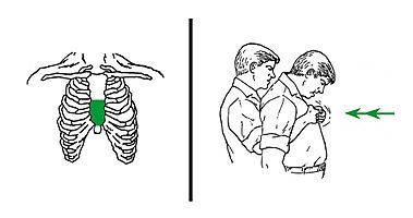 Archivo:Chest thrusts against choking