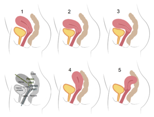 Archivo:Positions of the human uterus 1