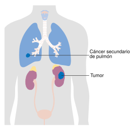 Diagram showing stage 4 kidney cancer CRUK 231-es