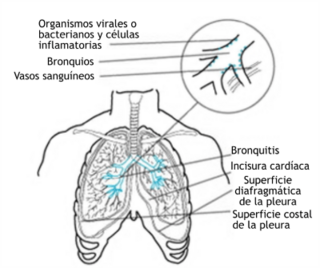 Archivo:Acute-bronchitis-es