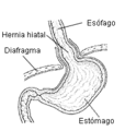 Esquema de hernia de hiato