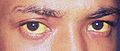 Jaundice eye new