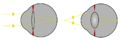 Focus in an eye