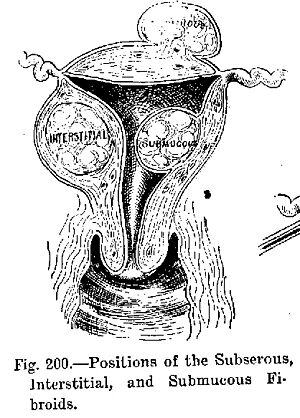 Archivo:Fibroids