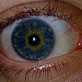 Central Heterochromia, Blue & Yellow Eye