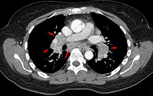 Archivo:Sarkoidose1 CT axial