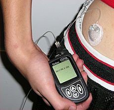 Archivo:Insulin pump with infusion set