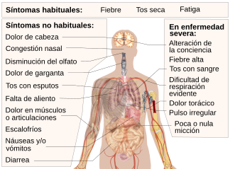 Symptoms of coronavirus disease 2019 2.0-es.svg