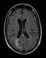 BrainToxoplasmosis MRI 2 09