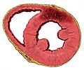 Heart ant wall infarction