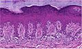 Histopathology of acral lentiginous melanoma in situ, intermediate magnification