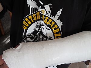 Archivo:Brazo escayolado por rotura de muñeca