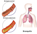 Bronchitis-es