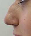 Hump nose2