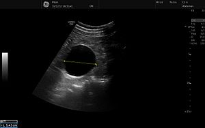 Archivo:Renal cyst ultrasound 3
