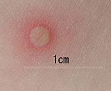 Archivo:Chickenpox blister-(closeup)