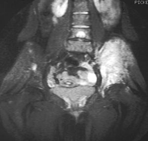 Archivo:Ewing's sarcoma MRI nci-vol-1832-300