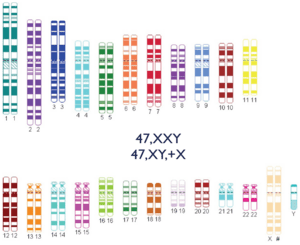 Human karyotype with extra X chromosome.png
